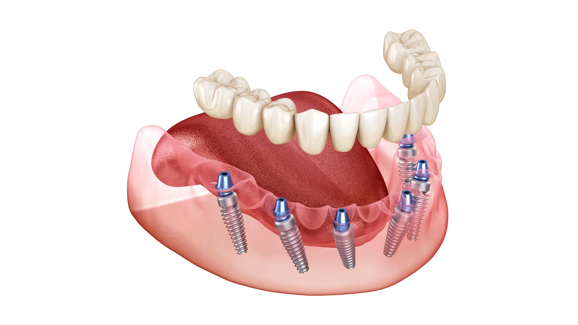 Протезирование зубов инвалидам 3 группы. Несъемный протез на 4 имплантах. Внутрислизистые зубные имплантаты.