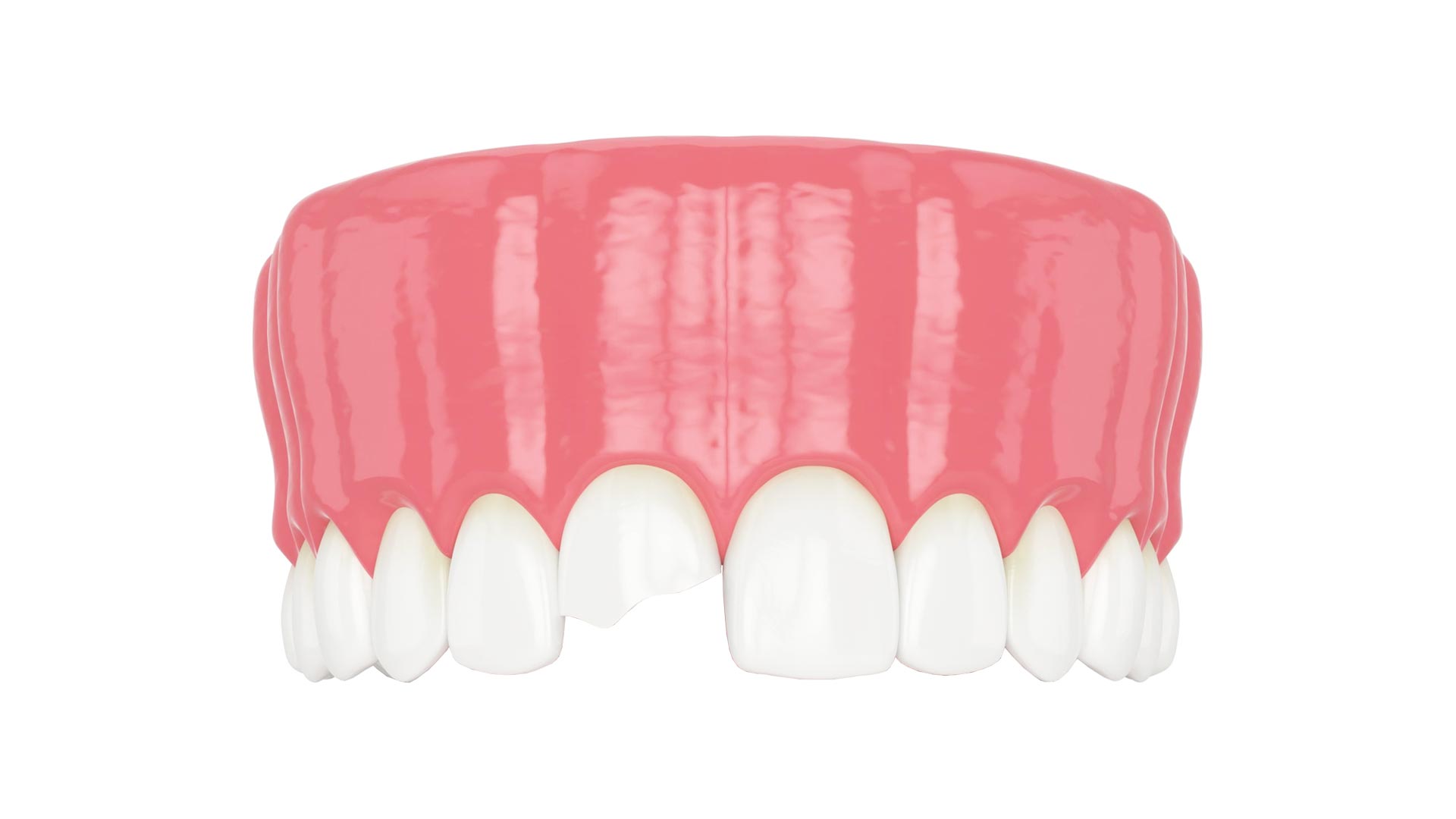 Composite Bonding Antalya Dent Smile