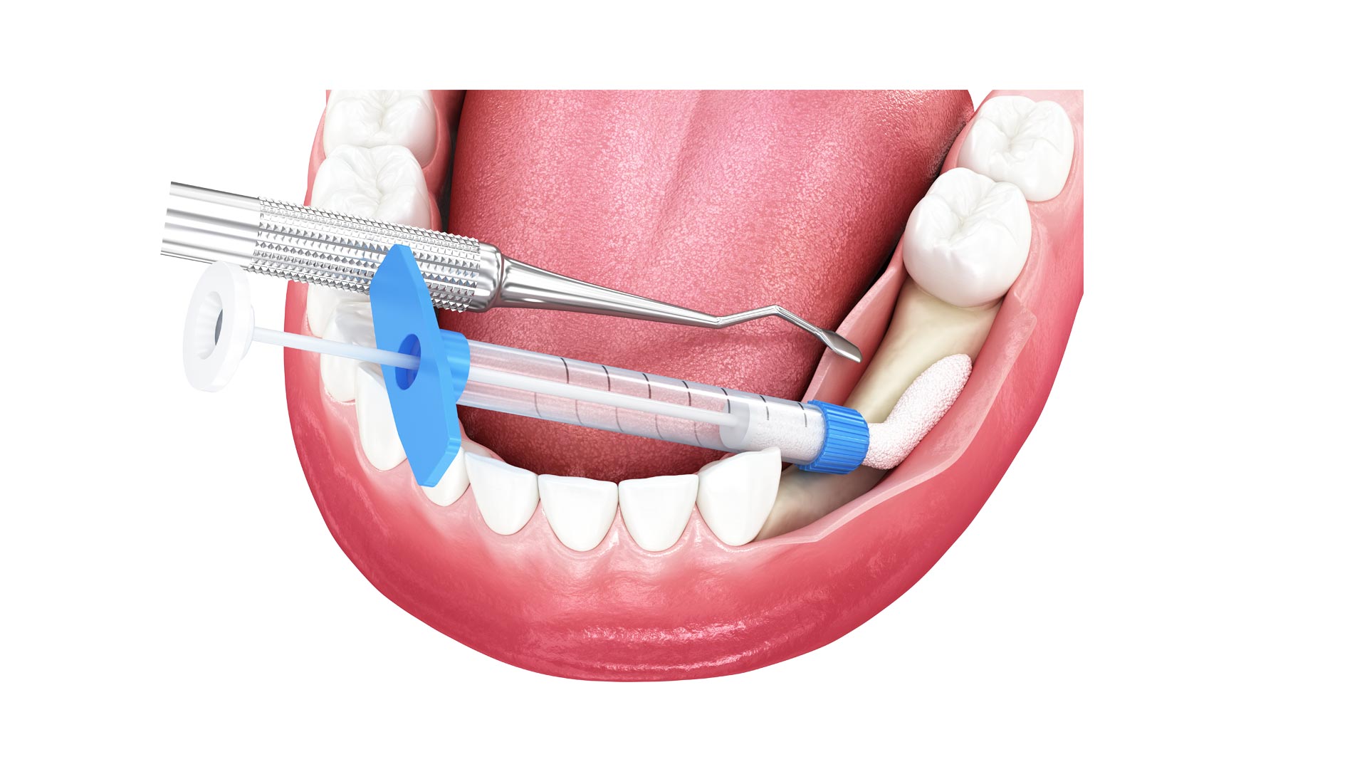 Dental Bone Grafting Antalya Dent Smile