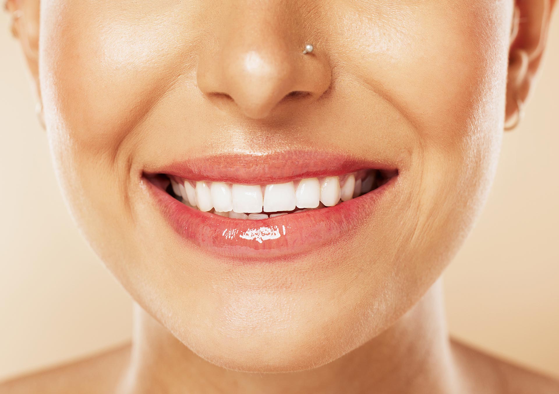 Are Veneers Permanent? Antalya Dent Smile