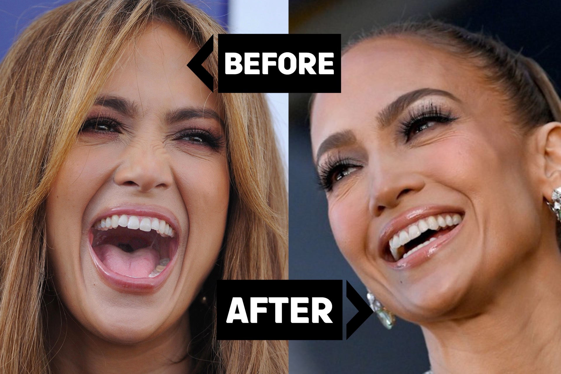 Jennifer Lopez's Ageless Transformation - Antalya Dent Smile